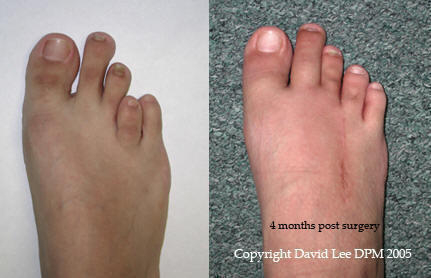 Before and After Photos - Arches Foot Institute Surprise AZ Podiatrist  Surprise AZ Foot Doctor