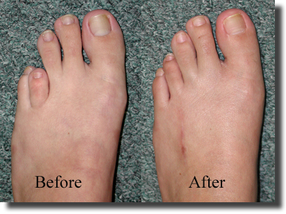 Brachymetatarsia Short Toe Surgery Arches Foot Institute Surprise Az Podiatrist Surprise Az Foot Doctor