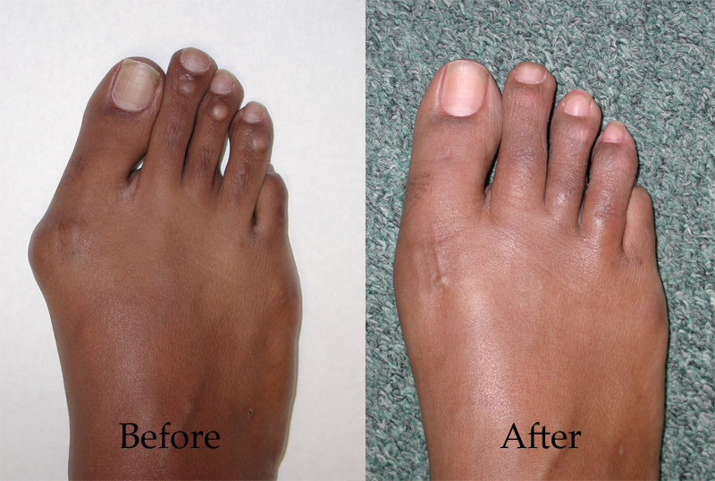 Hammertoe Correction without Surgery - The Foot Practice Podiatry Clinic