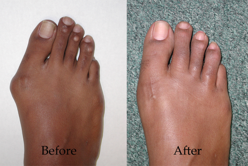 The Consequences of Hammertoe