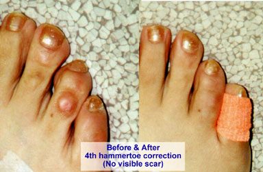 Hammertoe Treatment & Repair Surgery