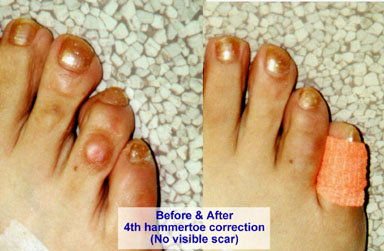 Hammertoe Surgery - Arches Foot Institute Surprise AZ Podiatrist Surprise  AZ Foot Doctor