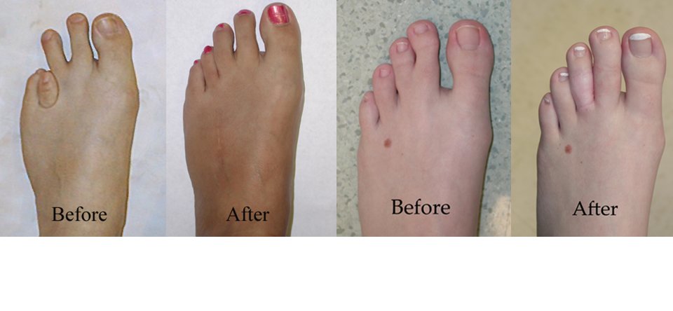 Restorative Foot Surgery