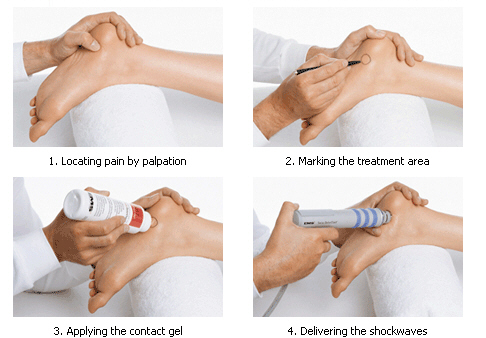 heel pain treatment