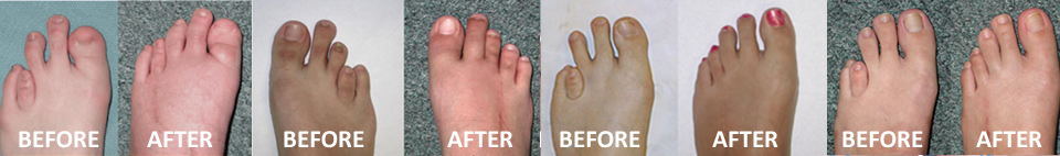Restorative Foot Surgery™