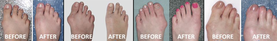 Restorative Foot Surgery™
